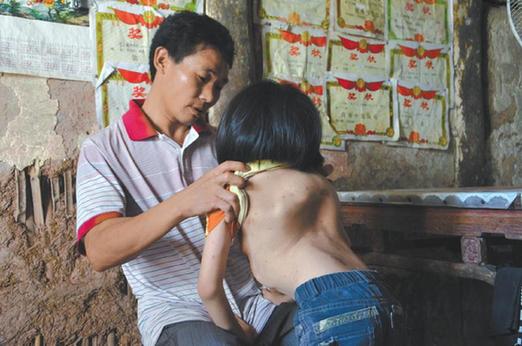有嚴重脊椎畸形及胸腔隆突病的李文霞。