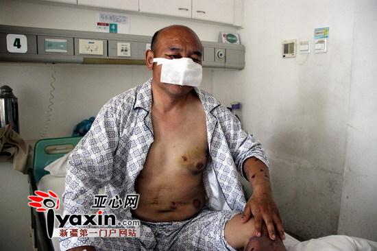新疆沙灣村民山中撿玉遭棕熊攻擊 鼻子、上嘴唇被咬掉撿回一命（圖）