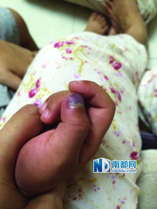 小逸手指被夾傷。