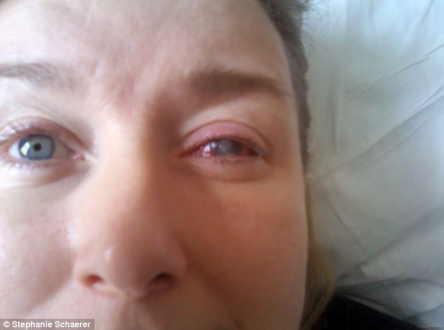 恐怖慎入！隱形眼鏡致英女子摘除眼球