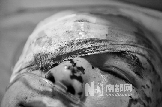 李建新頭部還有被潑硫酸的痕跡，醫(yī)生說被砍傷的右眼已經(jīng)失明。 南都記者 田飛 攝