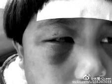 6月2日，網(wǎng)曝渭南市臨渭區(qū)一不滿5歲的女童遭奶奶毆打，眼圈青腫，引起網(wǎng)友關(guān)注，但孩子父母和爺爺均稱是摔倒導(dǎo)致。相關(guān)部門介入調(diào)查發(fā)現(xiàn)確為奶奶毆打所致，鑒于其身體原因已進行批評教育。