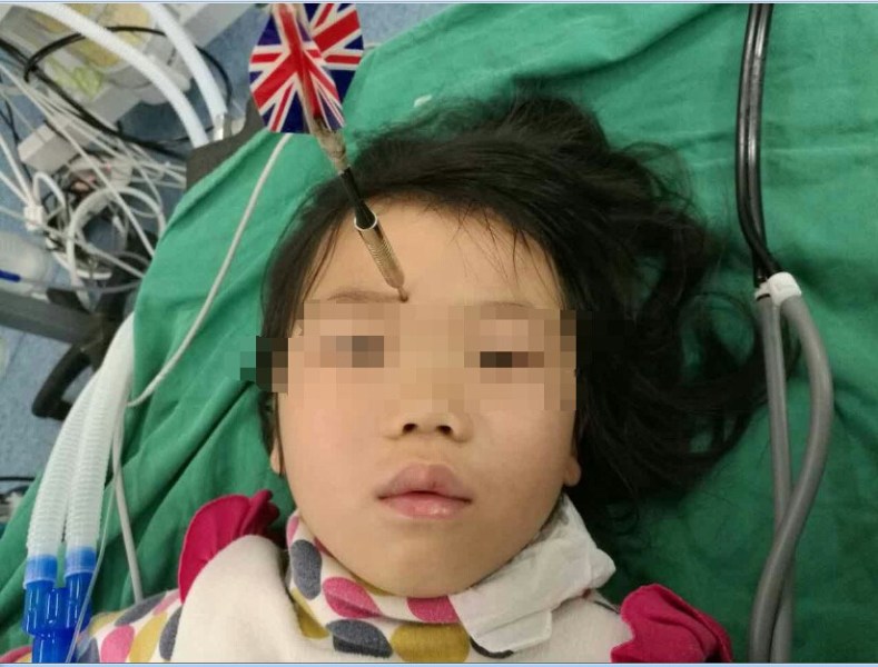 十多公分長的飛鏢穩(wěn)穩(wěn)地 ” 定 ” 在了一名六歲半的女童額頭上，小青一家人凌晨從長順趕到貴醫(yī)附院急診室時，看到如此慘烈的情況，接診醫(yī)生都嚇了一跳。詳細詢問下得知，原來是七歲的哥哥和六歲半的表妹在玩耍時，哥哥不慎將路邊撿來的真飛鏢扎到了妹妹的額頭上。