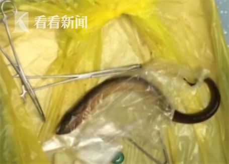 黃鱔從肛門鉆進(jìn)肚子 男子被送醫(yī)不愿多談事情經(jīng)過(guò)
