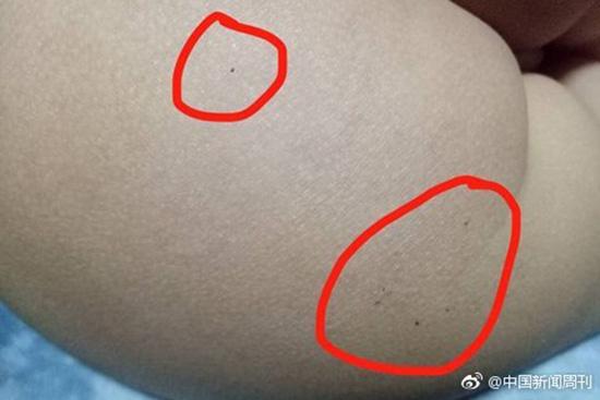 據多名紅黃藍(新天地分園)家長反映，孩子腿部、屁股、腋下出現針眼。