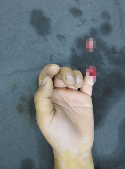 嚇哭！6歲男孩被夾斷手指 罪魁禍?zhǔn)拙故切７? oldsrc=