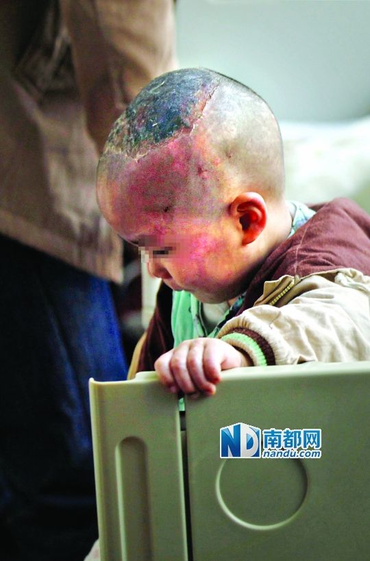 1月8日下午，小寶頭上和臉上都是傷痕。