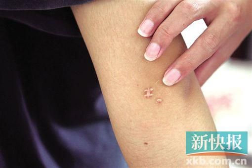 取出針后李星兒手臂留下了傷口。新快報記者 張國鋒/攝
