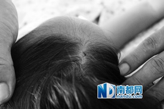 女童頭上被扎的針孔（圓圈處）。賈先生說，被扎不到三秒鐘，女兒就昏了。