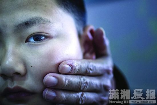 1月13日，小玨的父親心疼地摸著兒子的臉。
