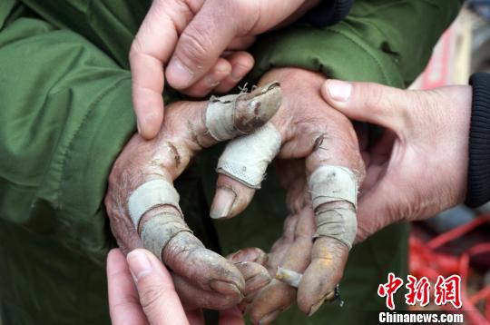 圖為由于常年拾荒，老人雙手布滿傷口。周小云 攝